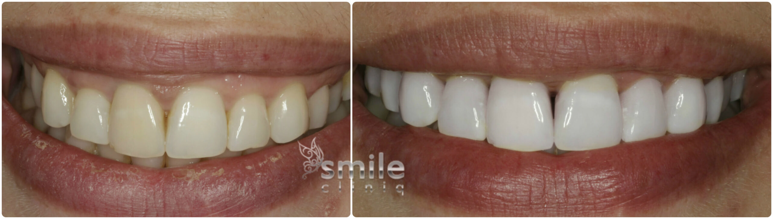 Enlighten Tooth Whitening Before and After