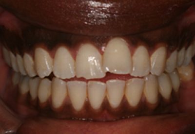 Inman Aligners Teeth Before