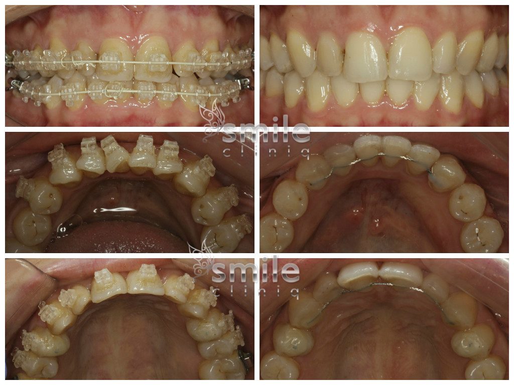 Six Month Smiles Before and After 12