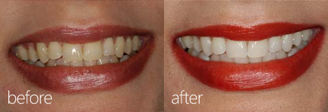 Tooth Whitening before and after