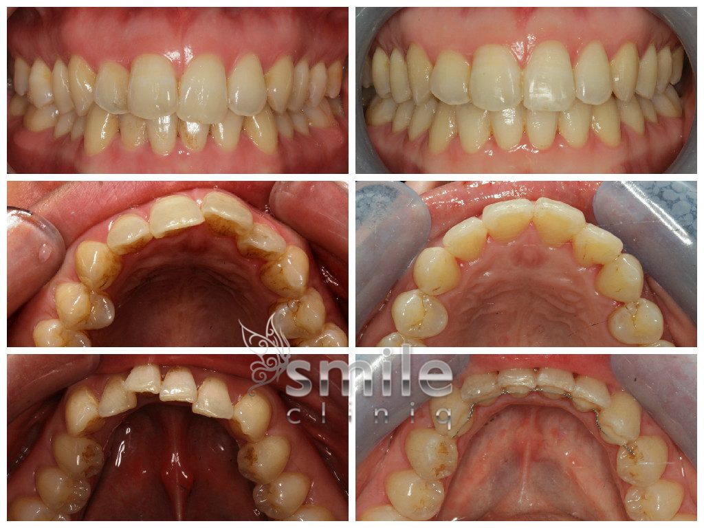 Six Month Smiles Before and After 15