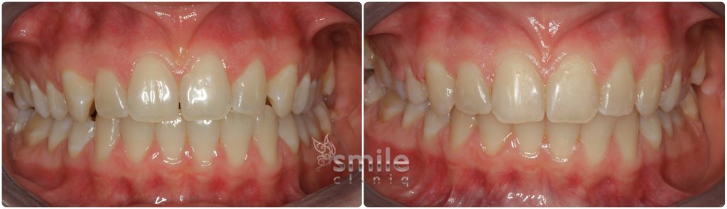 Six Month Smiles Before and After 16