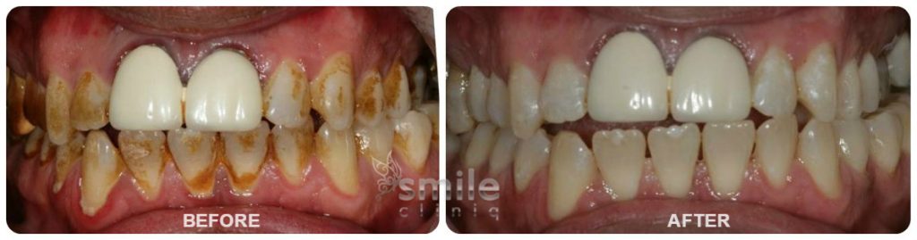 Dental Hygiene in London Before and After Treatment