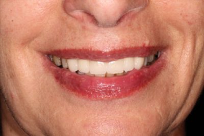 Dental bridge treatment after