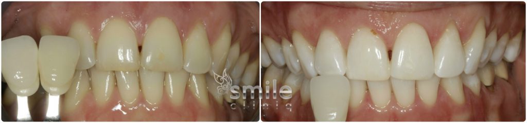 Enlighten Tooth Whitening Before and After 2