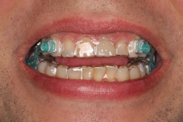 Manbdibular advancement splint