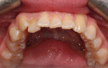 Invisalign Treatment London