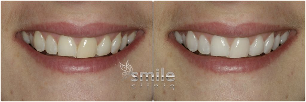 Enlighten Tooth Whitening Before and After 3