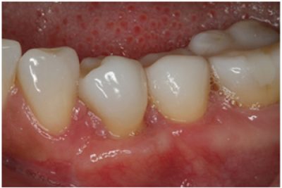 Treatment to receding gums after