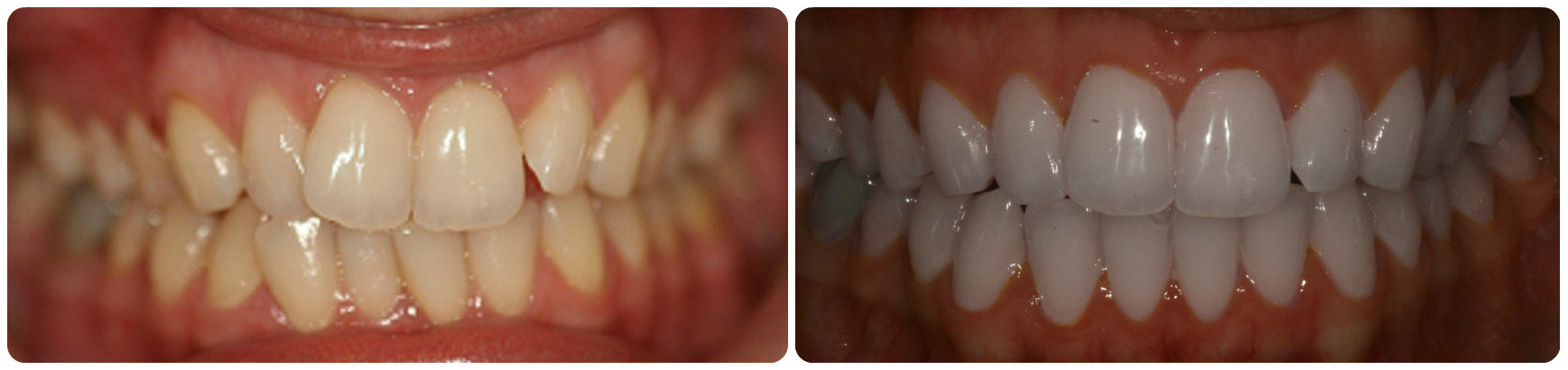 Lingual treatment before and after