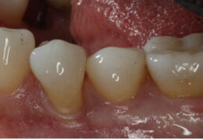 Treatment to receding gums before