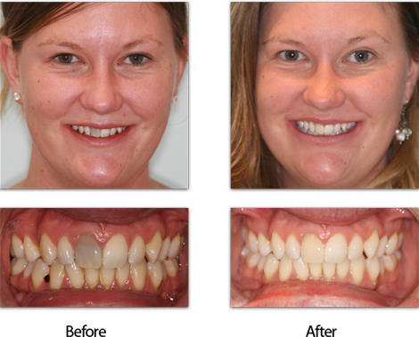 Dark Teeth Treatment Before and After