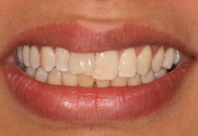 Teeth Before Inman Aligners London