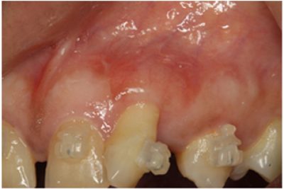 Receding Gums Treatment After