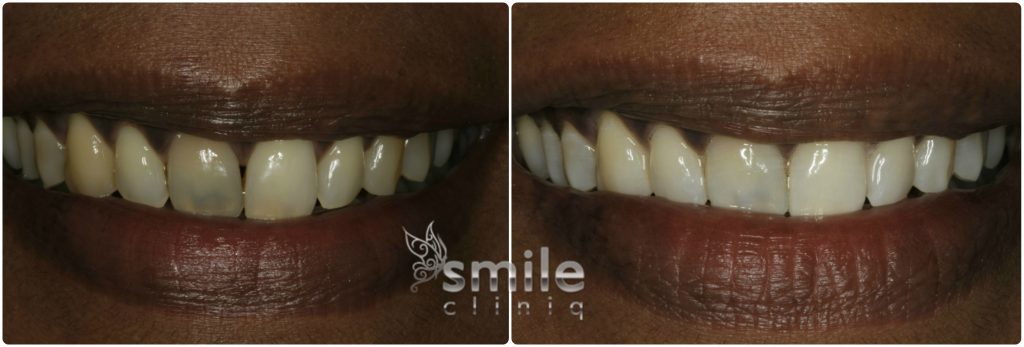 Enlighten Tooth Whitening Before and After 4