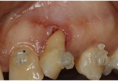 Receding Gums Treatment Before