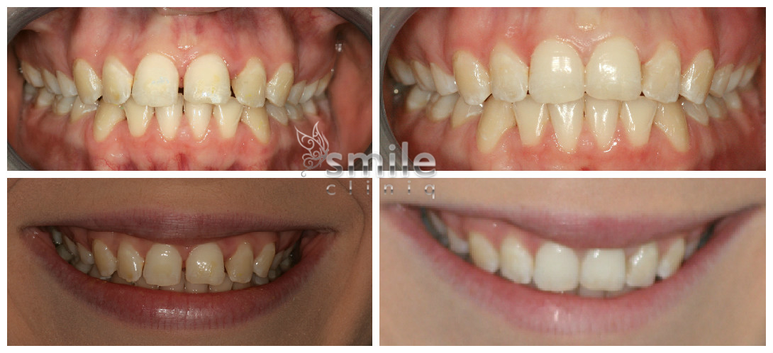 Lingual treatment in London before and after