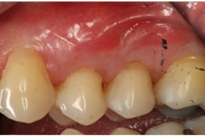 After treatment to receding gums