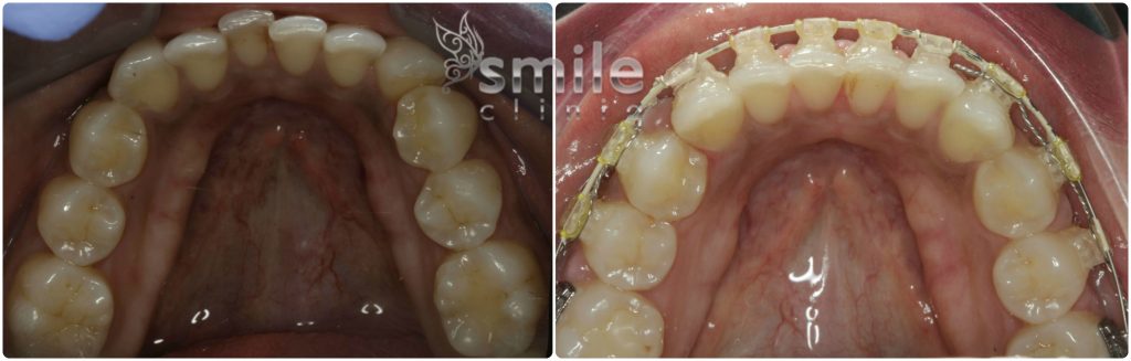 Six Month Smiles Before and After 6