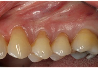 Before treatment to receding gums