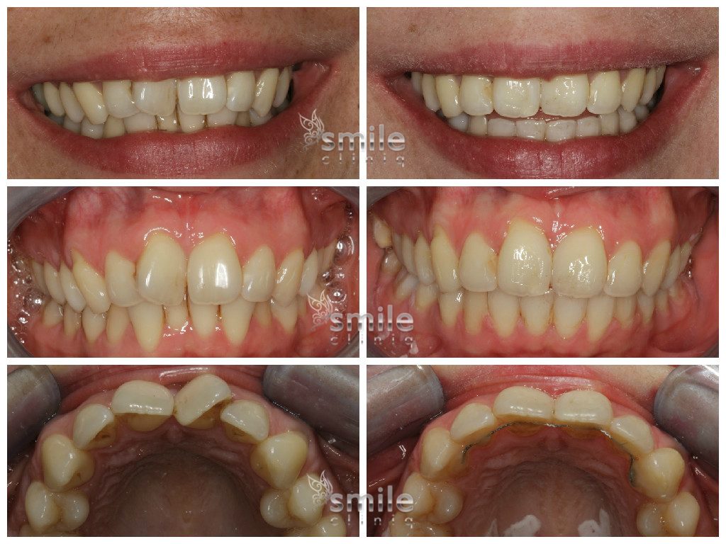 Six Month Smiles Before and After 9