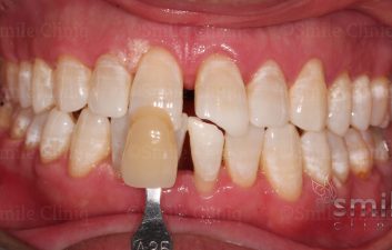 Enlighten Whitening London Dentist