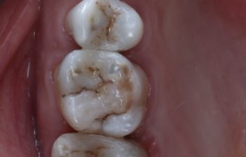 Amalgam Removal and composite placement after
