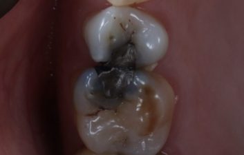 Amalgam Removal and composite placement before