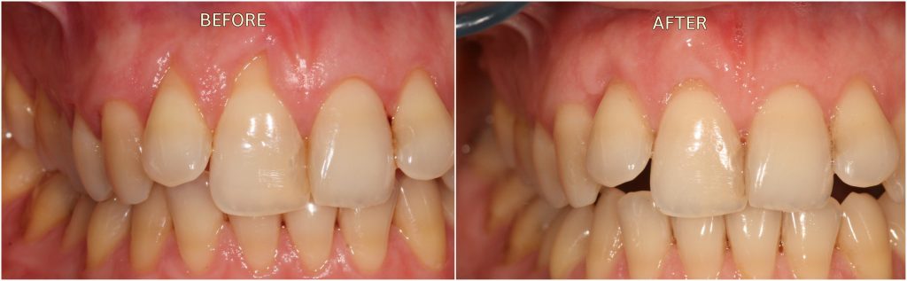 Receding Gums Treatment Before and After