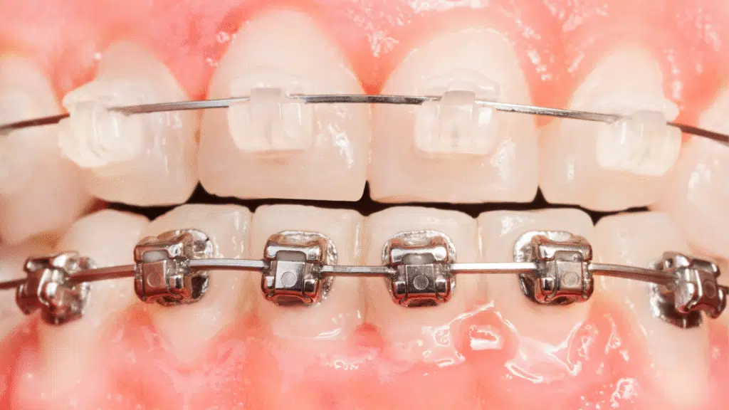Image of ceramic braces on teeth