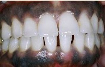 Gingival depigmentation before