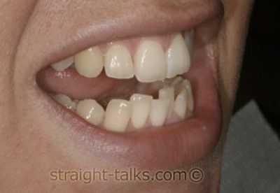 Inman Aligners in North London - Teeth Before