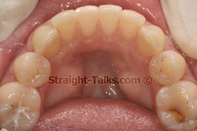 Inman Aligners with Smile Cliniq - Teeth After