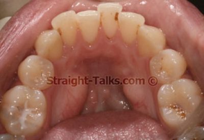 Inman Aligners with Smile Cliniq - Teeth Before