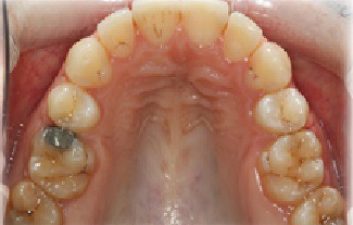 Ceramic-Brackets-orhodontics-after