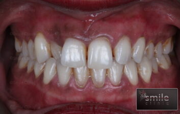 dark gums after london dentist