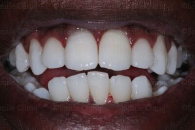 Teeth whitening dentist finchley london after