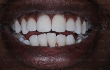 Dark incisor after