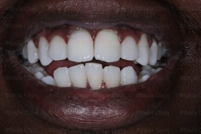 Dark incisor after