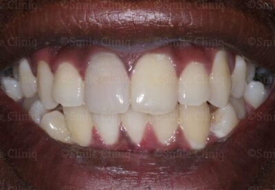Teeth whitening dentist finchley london before