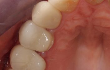 Dental crowns in London after