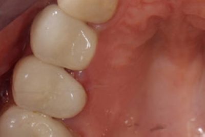 Mercury Filling Removal in London After
