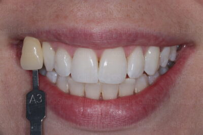 Enlighten whitening after