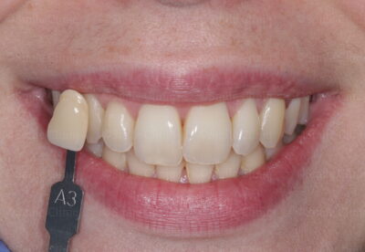 Enlighten whitening before