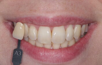 Enlighten whitening before