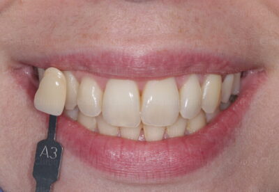 Enlighten whitening before