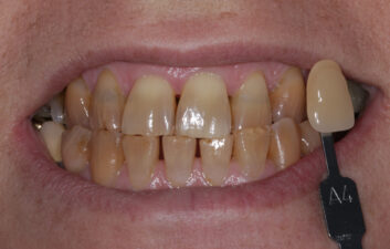 enlighten_whitening_treatment_london_before