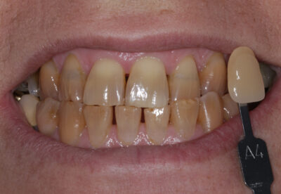 enlighten whitening london before