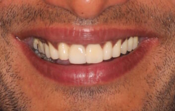 Front tooth implant after