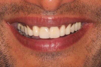 Front tooth implant after